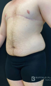 Liposuction Before and After Pictures in Buffalo, NY