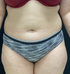 Liposuction Before and After Pictures in Buffalo, NY