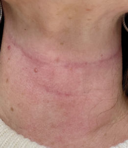 Neck Fillers Before and After Pictures in Buffalo, NY