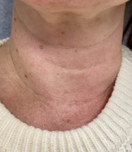 Neck Fillers Before and After Pictures in Buffalo, NY