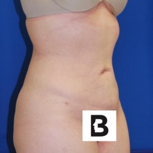 Liposuction Before and After Pictures Buffalo, NY