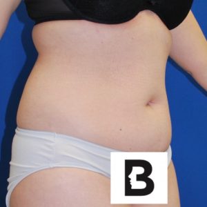 Liposuction Before and After Pictures Buffalo, NY