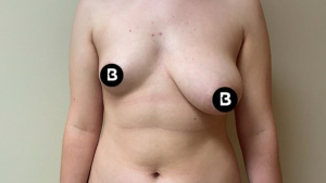 Breast Reduction Before and After Pictures in Buffalo, NY