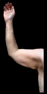 Brachioplasty (Arm Lift) Before and After Pictures Buffalo, NY