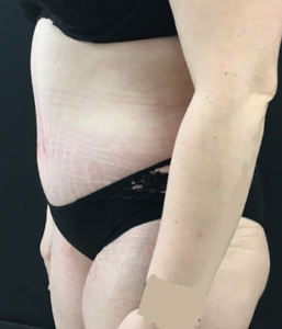 Abdominoplasty (Tummy Tuck) Before and After Pictures Buffalo, NY