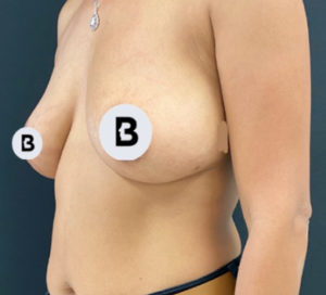 Breast Augmentation Before and After Pictures Buffalo, NY