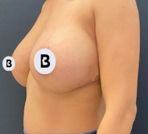 Breast Augmentation Before and After Pictures Buffalo, NY