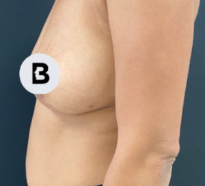 Breast Augmentation Before and After Pictures Buffalo, NY