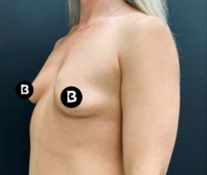 Breast Augmentation Before and After Pictures in Buffalo, NY