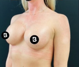 Breast Augmentation Before and After Pictures in Buffalo, NY