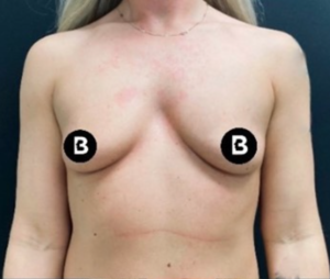 Breast Augmentation Before and After Pictures in Buffalo, NY
