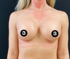 Breast Augmentation Before and After Pictures in Buffalo, NY