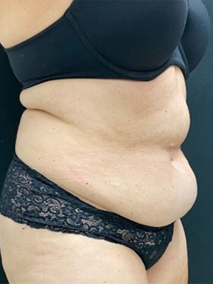 Abdominoplasty (Tummy Tuck) Before and After Pictures in Buffalo, NY