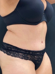 Abdominoplasty (Tummy Tuck) Before and After Pictures in Buffalo, NY