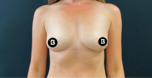 Breast Augmentation Before and After Pictures in Buffalo, NY