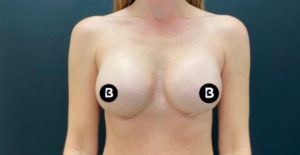 Breast Augmentation Before and After Pictures in Buffalo, NY