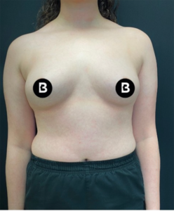 Breast Augmentation Before and After Pictures in Buffalo, NY