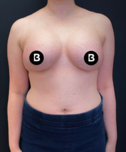 Breast Augmentation Before and After Pictures in Buffalo, NY