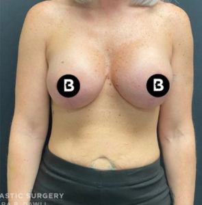 Breast Augmentation Before and After Pictures in Buffalo, NY