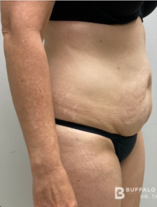 Abdominoplasty (Tummy Tuck) Before and After Pictures in Buffalo, NY