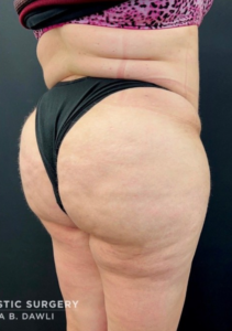 Brazilian Butt Lift Before and After Pictures in Buffalo, NY