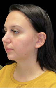 Facial Fat transfer Before and After Pictures in Buffalo, NY
