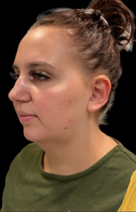Facial Fat transfer Before and After Pictures in Buffalo, NY