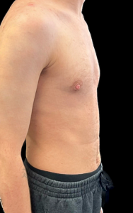 Female to Male Top Surgery Before and After Pictures in Buffalo, NY