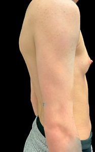 Female to Male Top Surgery Before and After Pictures in Buffalo, NY