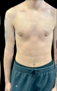 Female to Male Top Surgery Before and After Pictures in Buffalo, NY