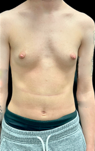 Female to Male Top Surgery Before and After Pictures in Buffalo, NY