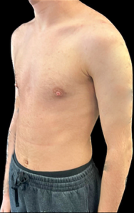 Female to Male Top Surgery Before and After Pictures in Buffalo, NY