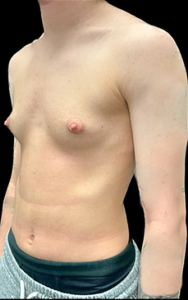 Female to Male Top Surgery Before and After Pictures in Buffalo, NY