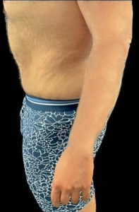 Abdominoplasty (Tummy Tuck) Before and After Pictures in Buffalo, NY
