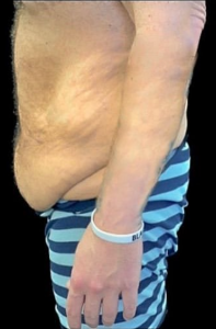 Abdominoplasty (Tummy Tuck) Before and After Pictures in Buffalo, NY