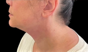 Necklift Before and After Pictures in Buffalo, NY