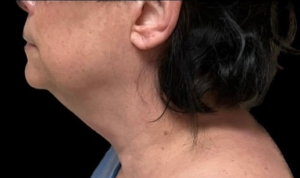 Necklift Before and After Pictures in Buffalo, NY