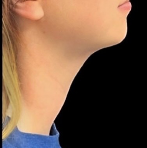 Chin Liposuction Before and After Pictures Buffalo, NY