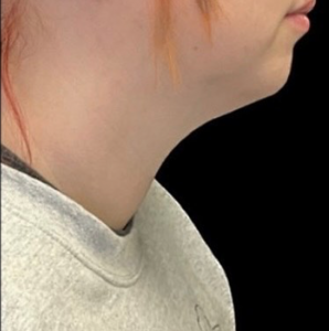 Chin Liposuction Before and After Pictures Buffalo, NY