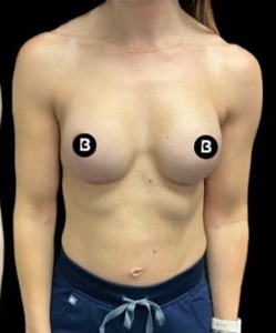 Breast Revisions Before and After Pictures in Buffalo, NY
