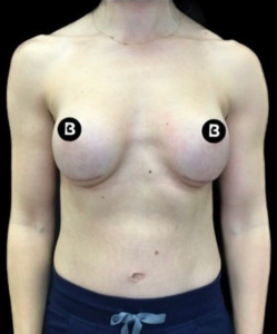 Breast Revisions Before and After Pictures in Buffalo, NY