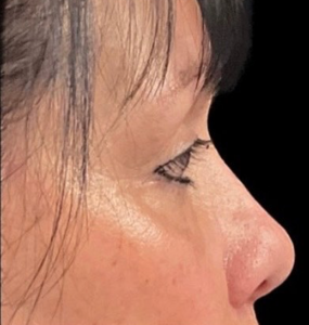 Blepharoplasty (Eyelid Surgery) Before and After Pictures in Buffalo, NY
