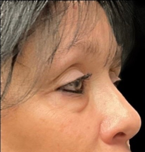 Blepharoplasty (Eyelid Surgery) Before and After Pictures in Buffalo, NY