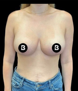 Breast Reduction Before and After Pictures in Buffalo, NY