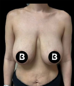 Breast Reduction Before and After Pictures in Buffalo, NY