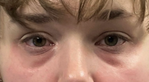 Tear Trough Fillers Before and After Pictures in Buffalo, NY