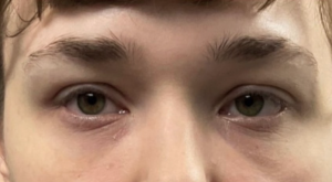 Tear Trough Fillers Before and After Pictures in Buffalo, NY