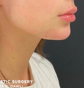 Chin Fillers Before and After Pictures Buffalo, NY