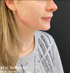 Chin Fillers Before and After Pictures Buffalo, NY
