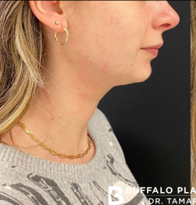 Chin Fillers Before and After Pictures Buffalo, NY